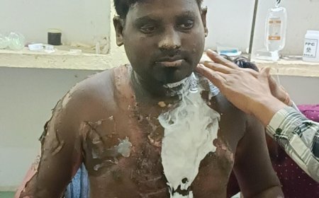 30 वर्षीय युवक आग से जलकर बुरी तरीके से हुआ घायल , किया गया रेफर