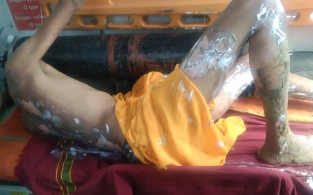 33 के वी की चपेट में आने से झुलसा मजदूर